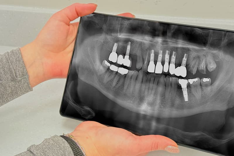 Dental Implants Treatment